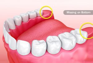 the teeth