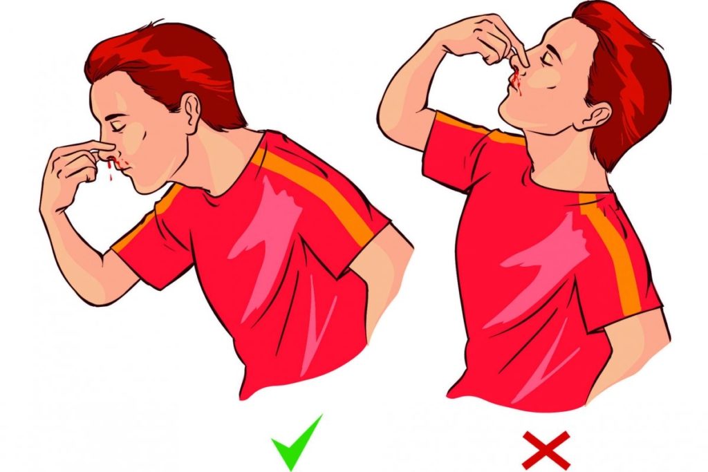 Basic First Aid for nose Bleeding basic science classnotesng