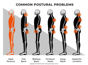 Types of Postural Defects 