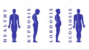 Types of Postural Defects 