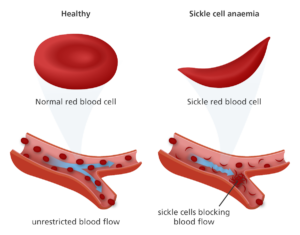 Nature of Sickle Cell and Obesity as Non- communicable Diseases
